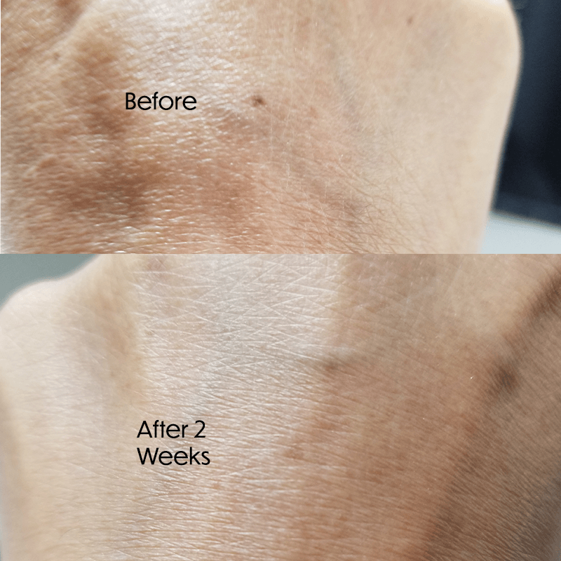ZENMED Skin Eraser Kit for Dark Spot Correction |