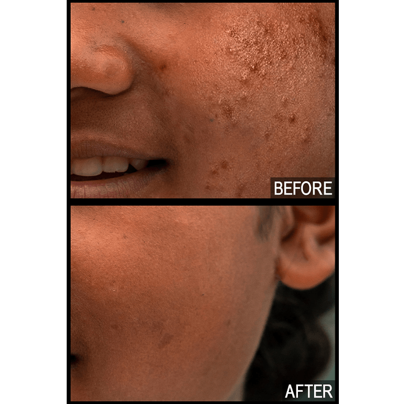 Glycolic Resurfacing Toner with Hyaluronic & Meadowsweet